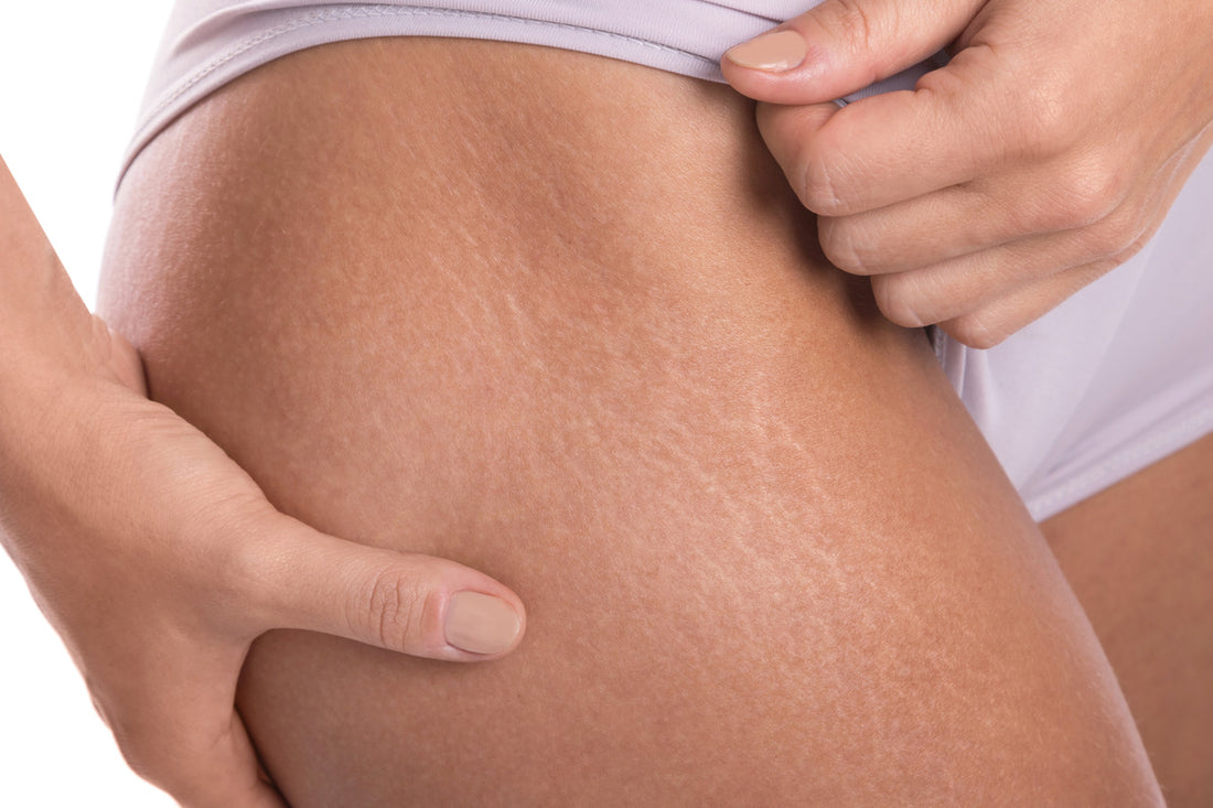 How to Get Rid of Stretch Marks
