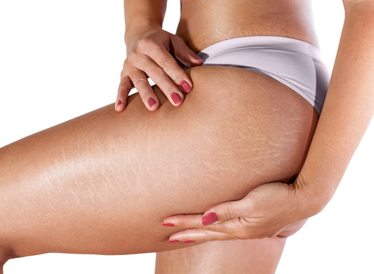 How To Get Rid Of Stretch Marks On Your Inner Thighs