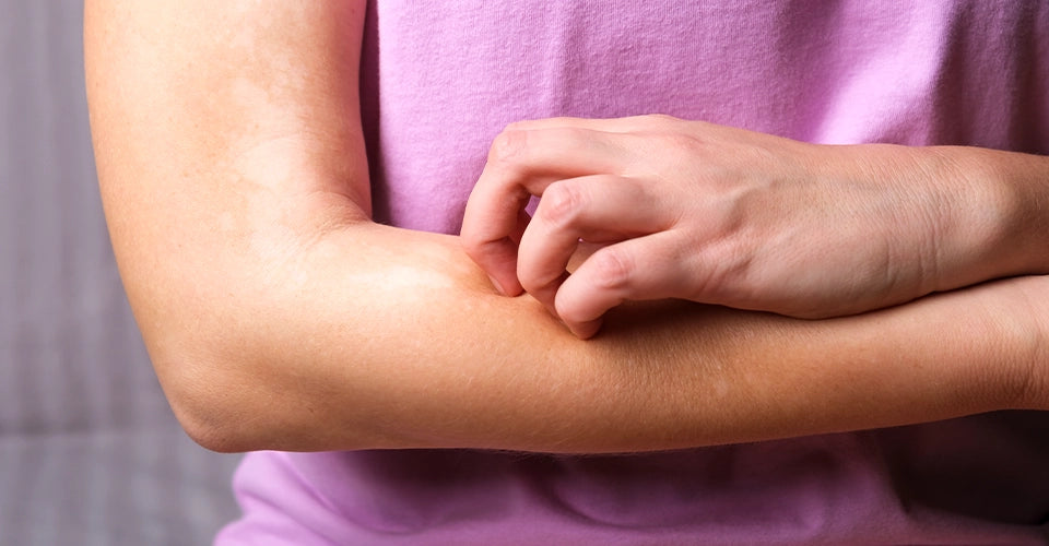Itchiness