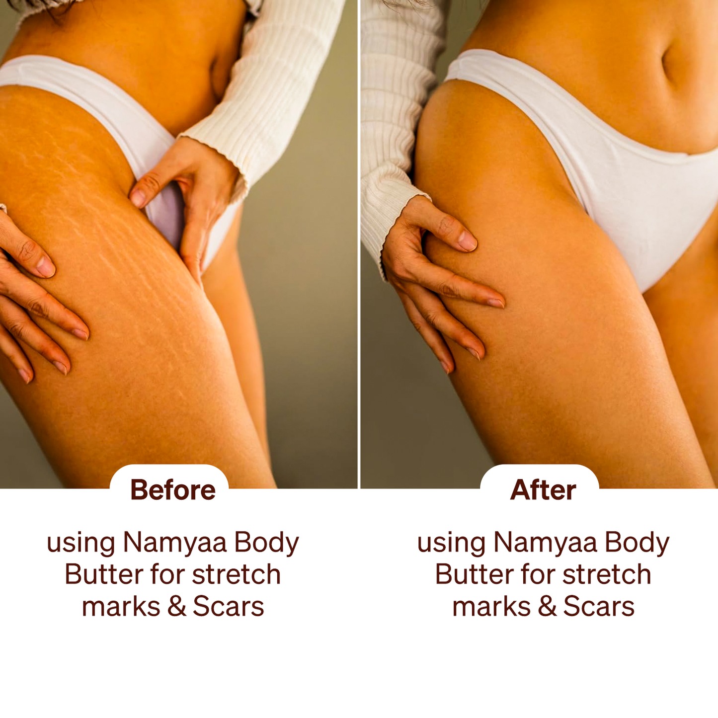 Body Butter for Stretch Marks & Scars