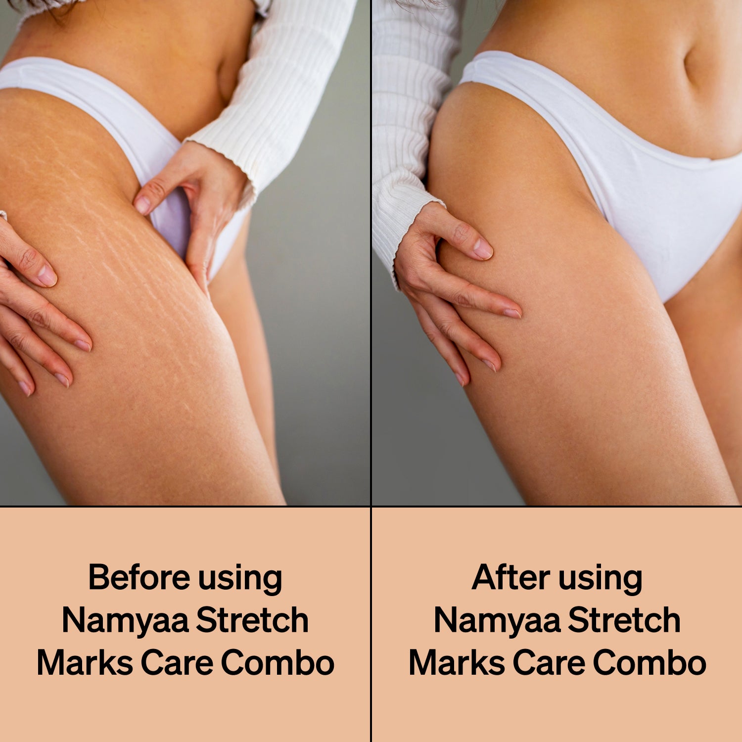 Stretch Marks Care Combo - Main Image